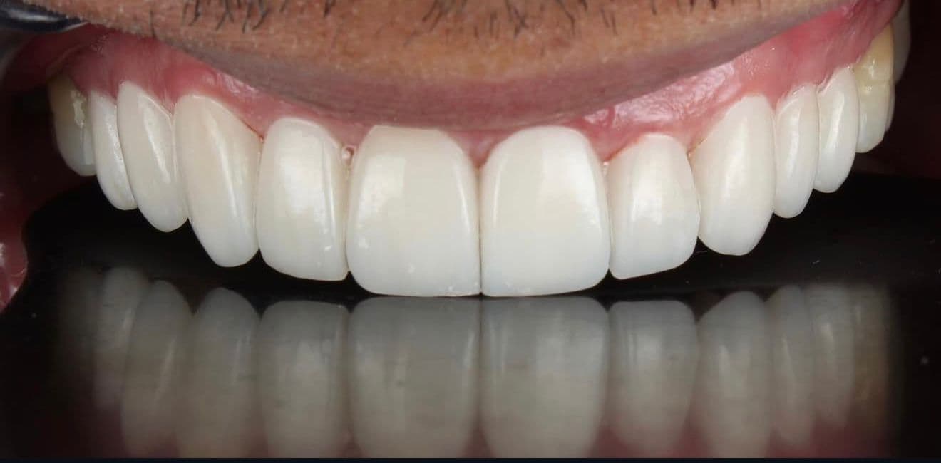 After ceramic dental veneers