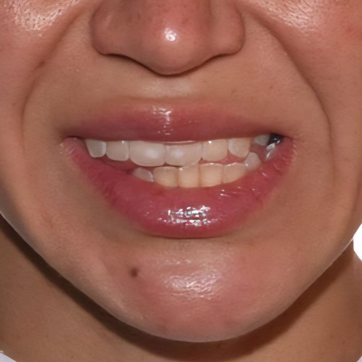 Before Orthognathic Surgery