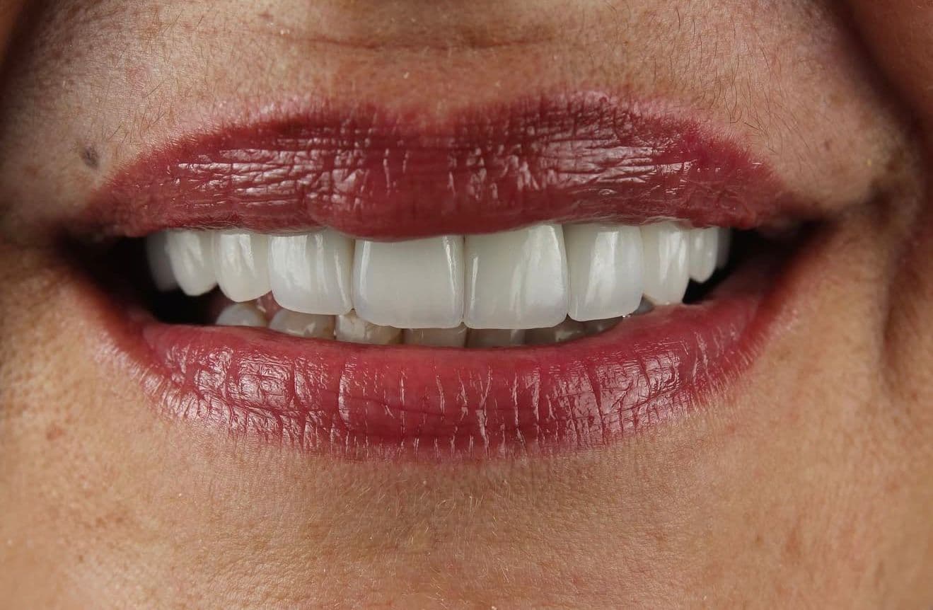 After ceramic dental veneers and implant
