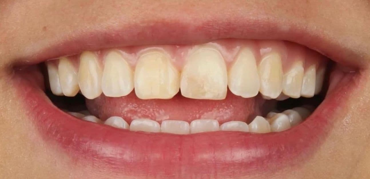 Before ceramic dental veneers