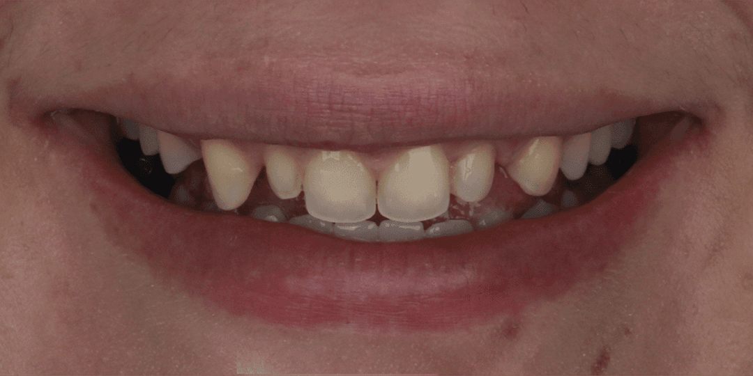 Before Ceramic Smile Design