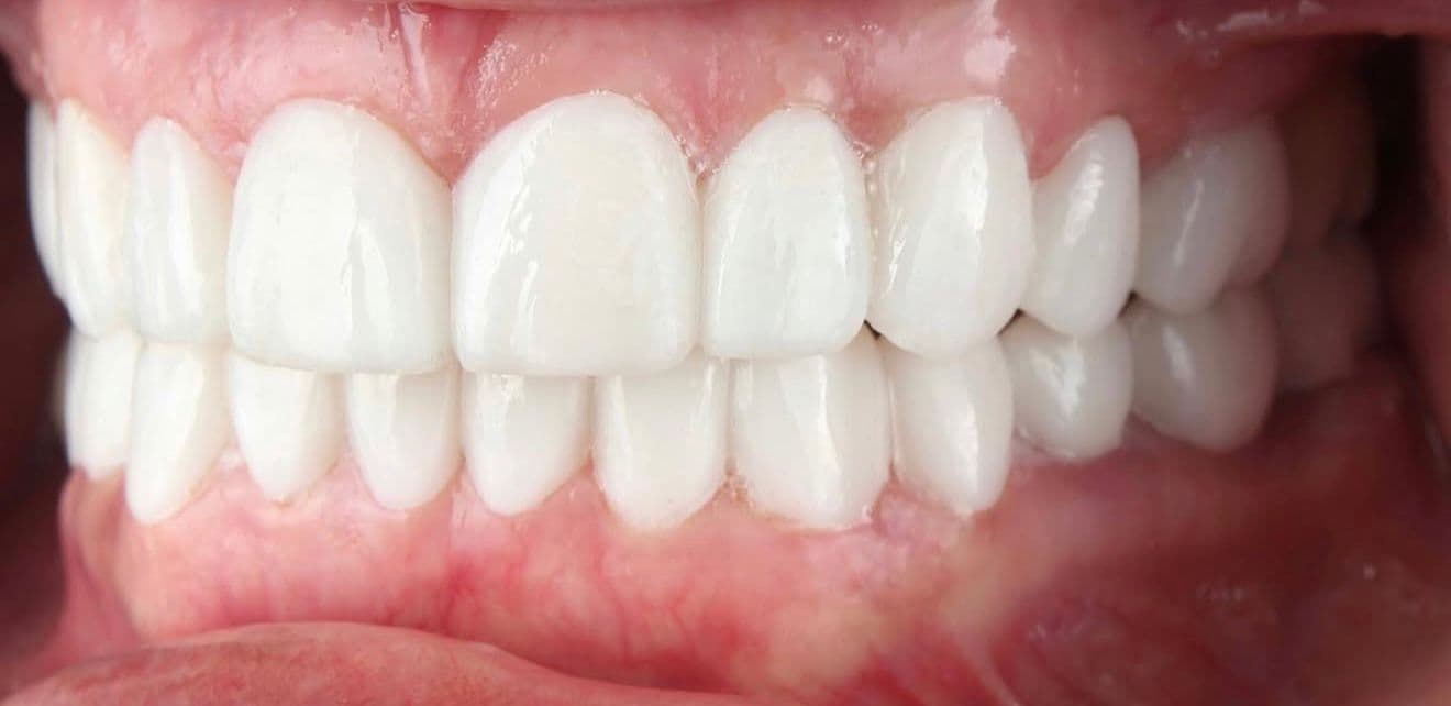 After ceramic dental veneers