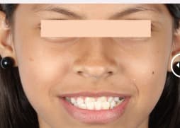 Before Invisible Orthodontics
