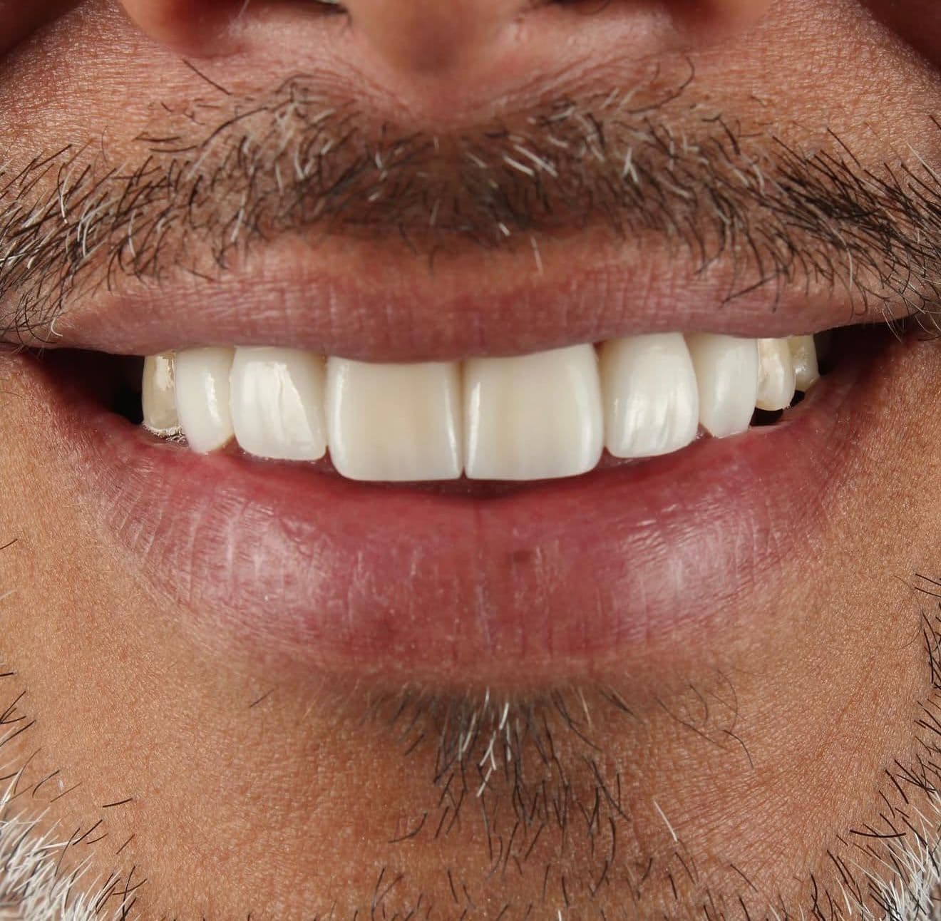 After ceramic dental veneers