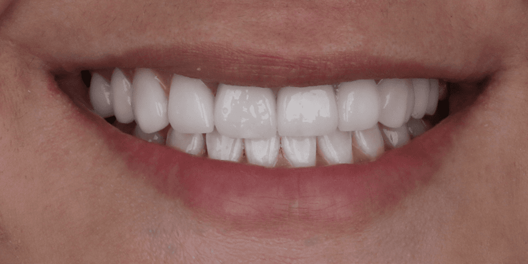 After Dental implants in aesthetic zone + Ceramic smile design