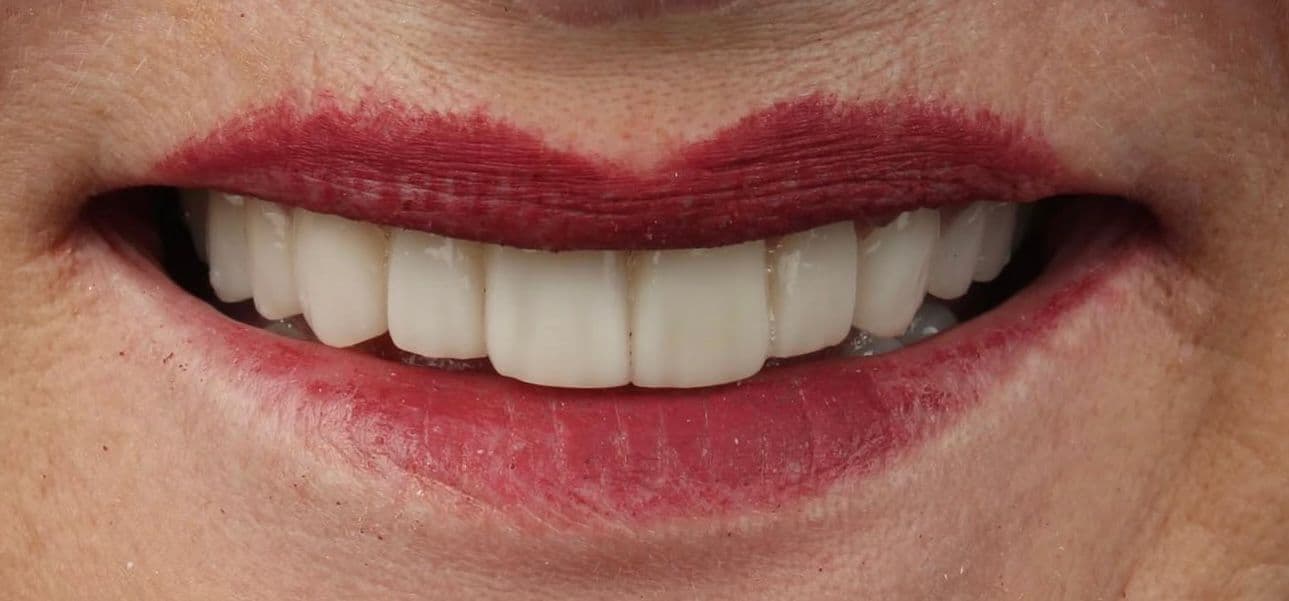 After ceramic dental veneers