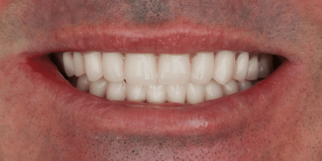After Bimaxillary hybrid prosthesis
