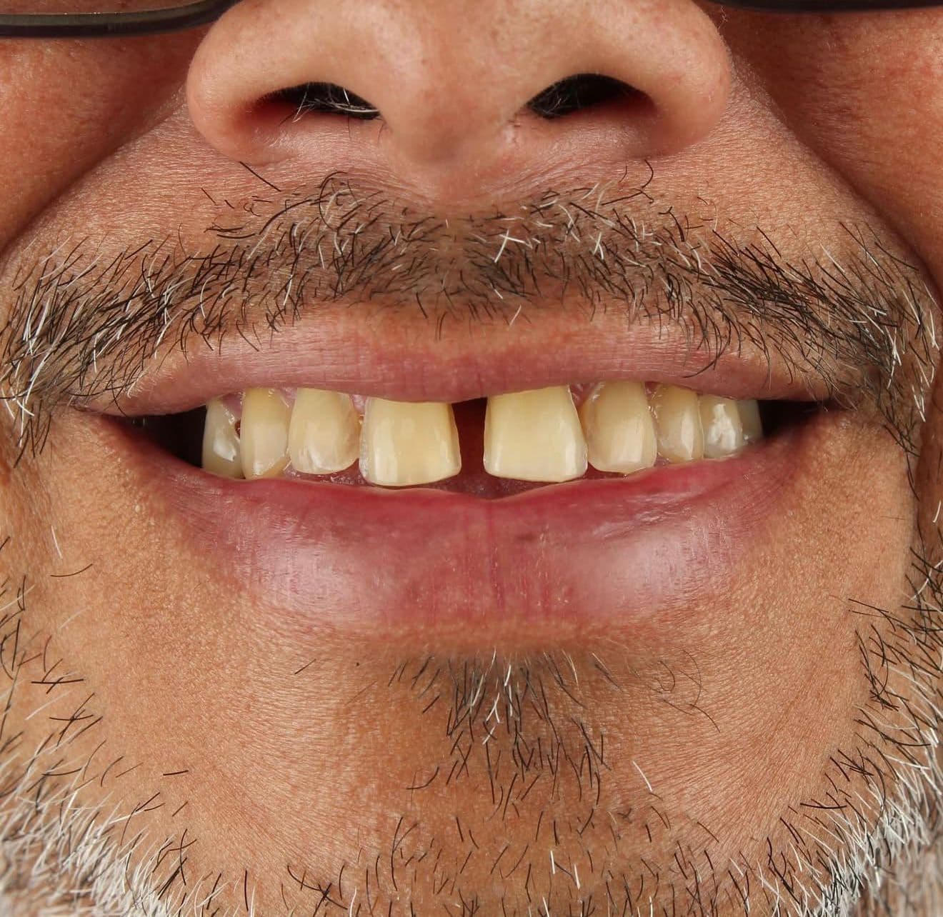 Before ceramic dental veneers