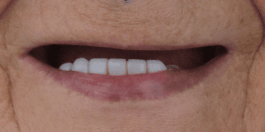 Before Upper hybrid prosthesis
