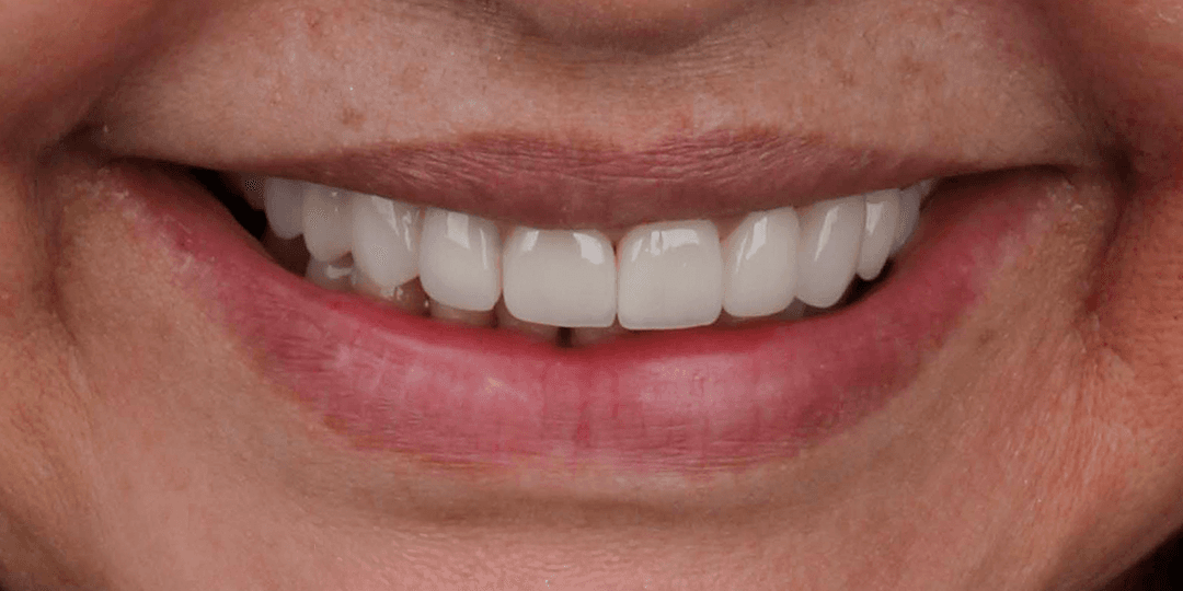 After Upper hybrid prosthesis