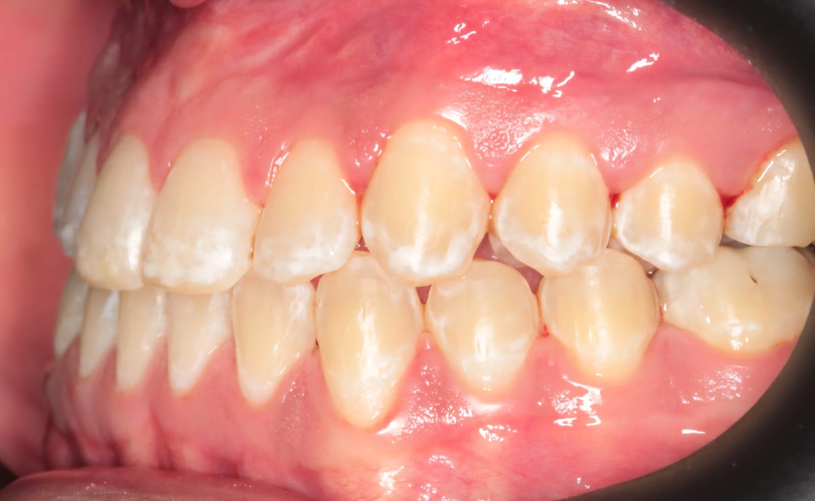 After Orthognathic Surgery