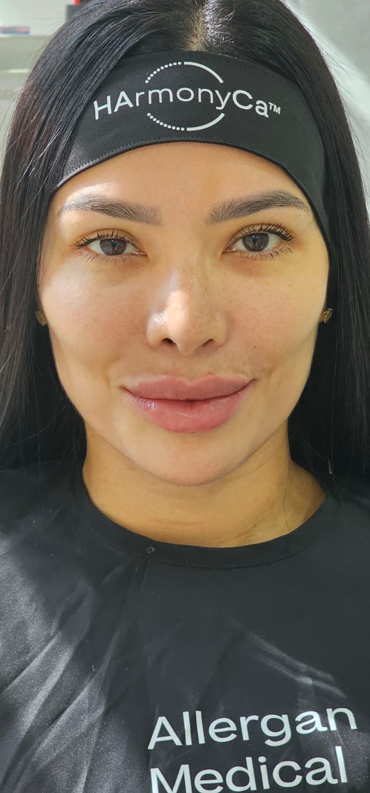 After Facial Harmonization