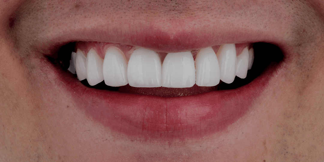 After Dental implant in aesthetic zone + Ceramic smile design
