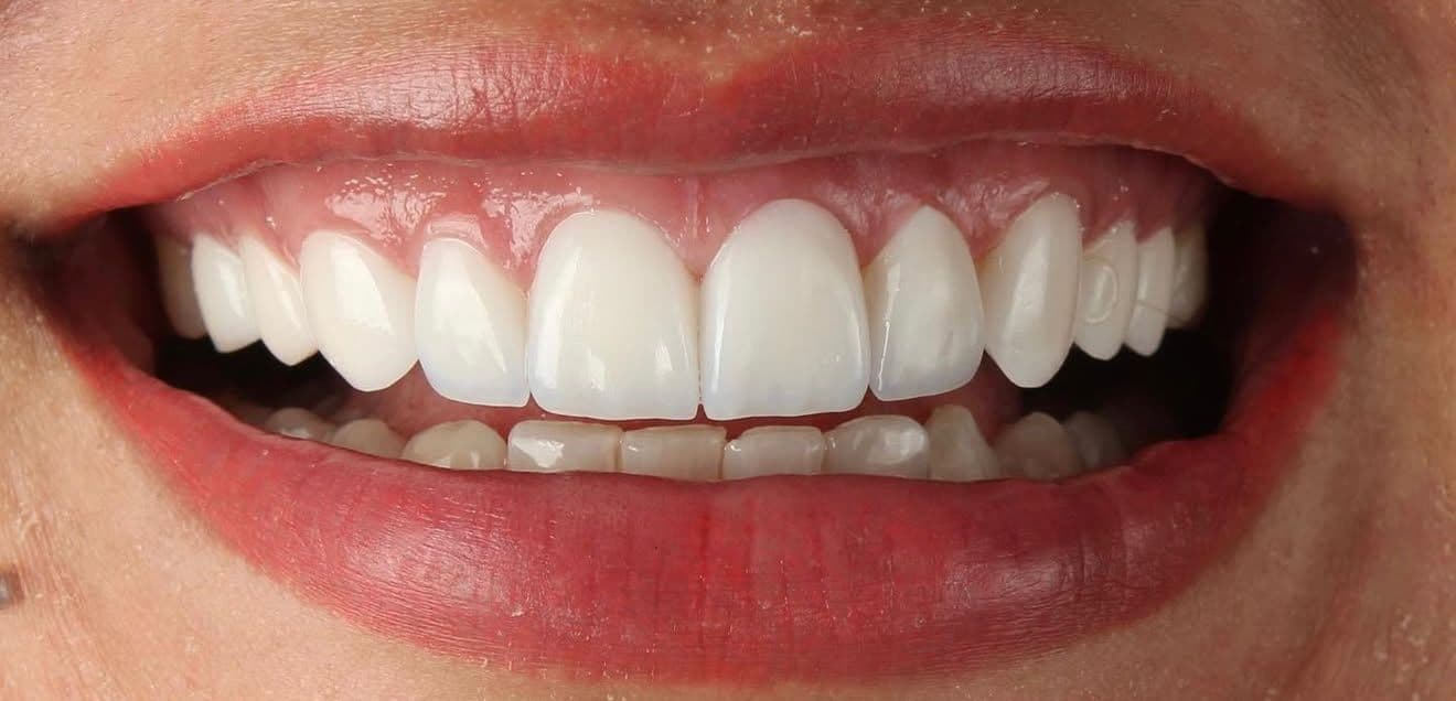 After ceramic dental veneers
