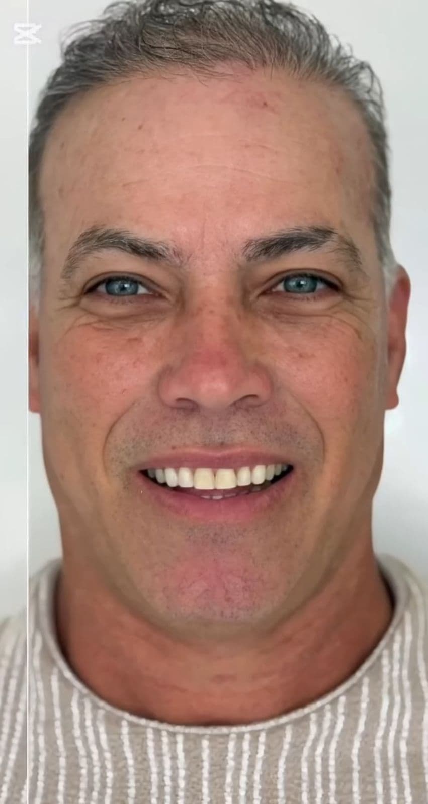 Before After orthodontics with aligners, CERAMIC LENSES are performed.