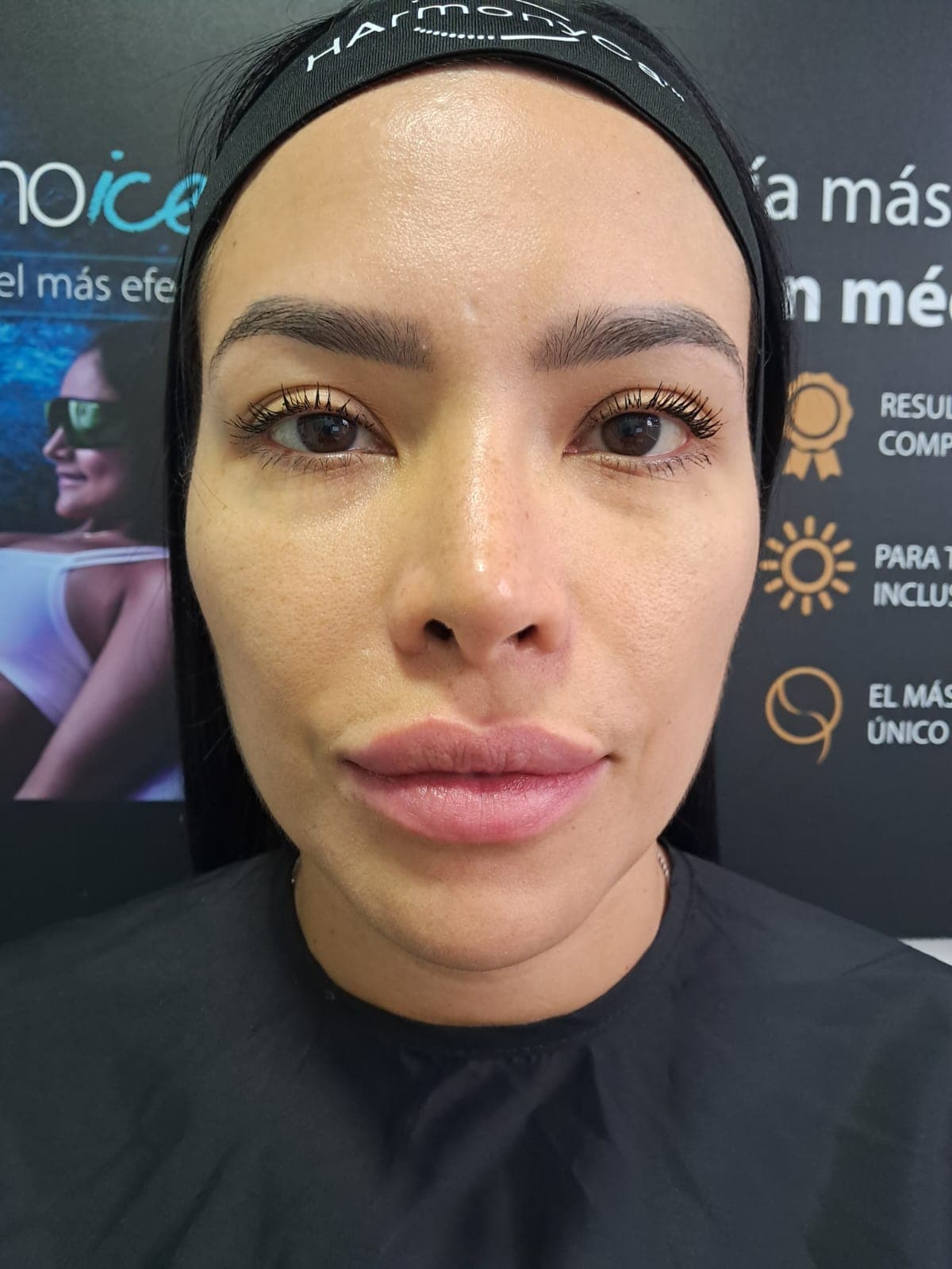 Before Facial Harmonization