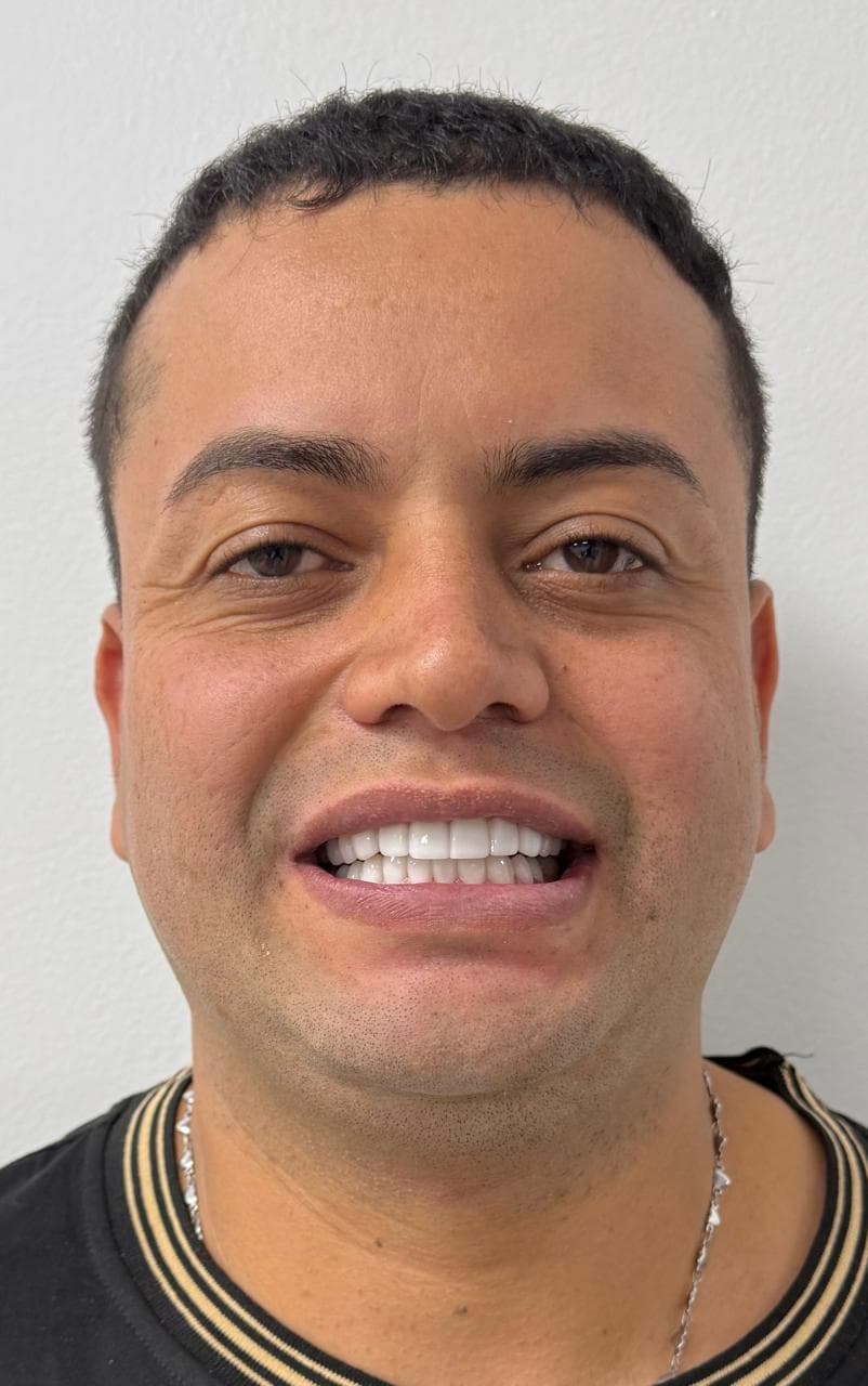 After CERAMIC LENSES