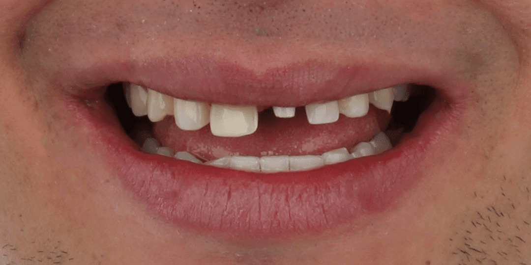 Before Dental implant in aesthetic zone + Ceramic smile design