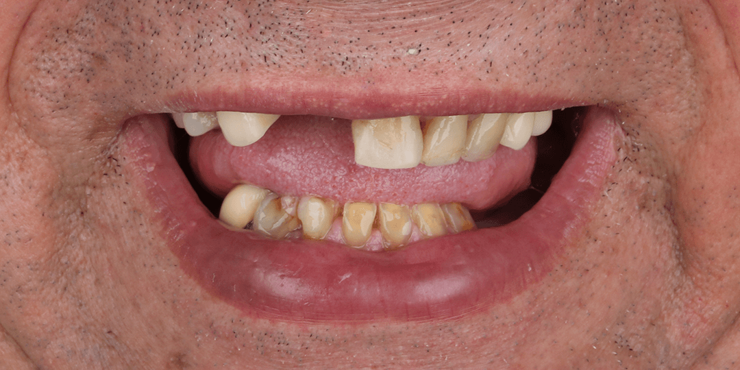 Before Bimaxillary hybrid prosthesis