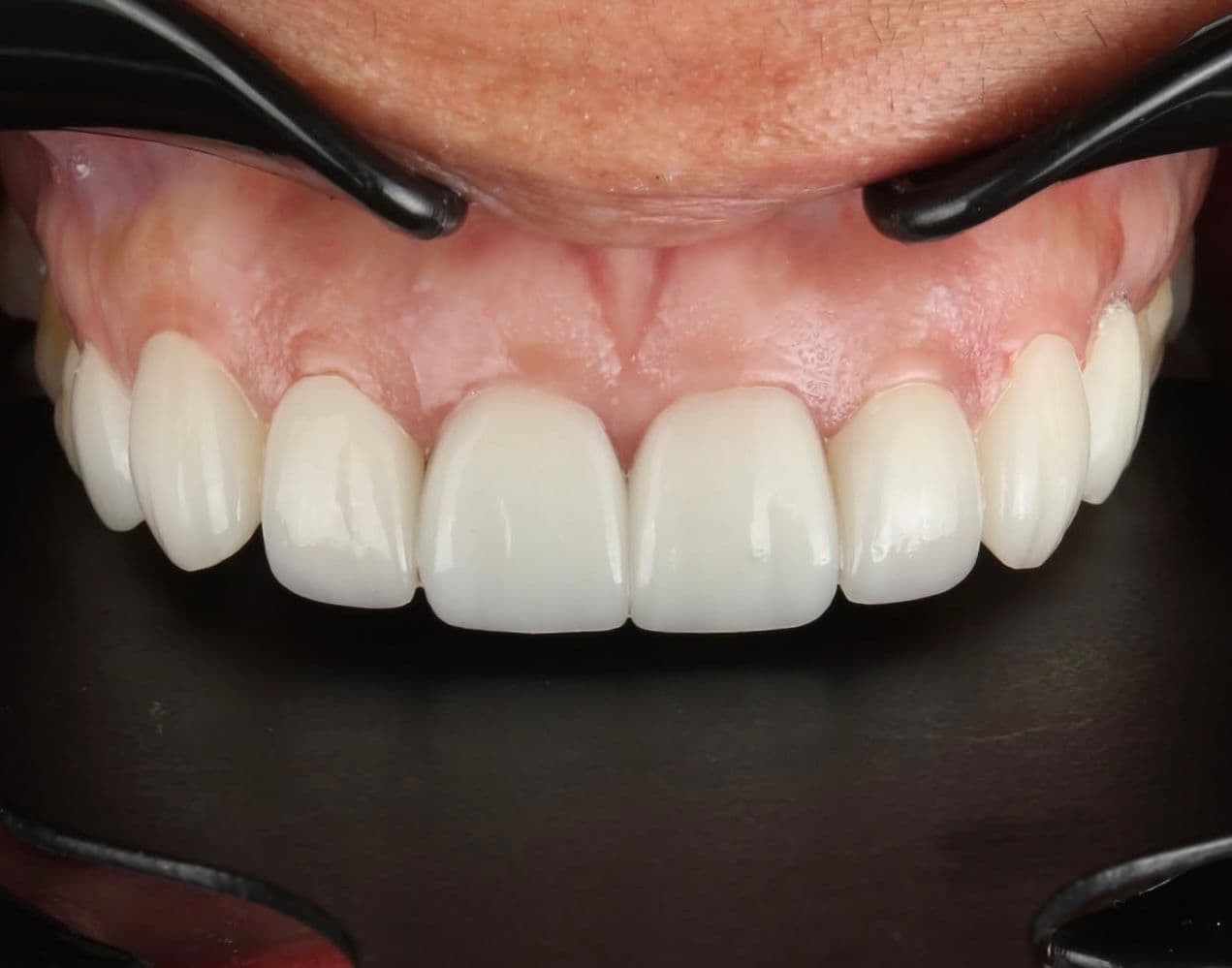 After ceramic dental veneers