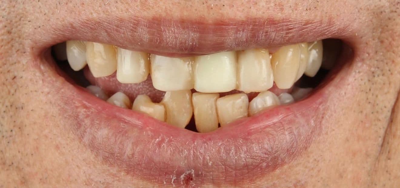 Before ceramic dental veneers