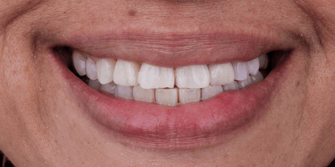 After Zirconia dental implant in aesthetic zone