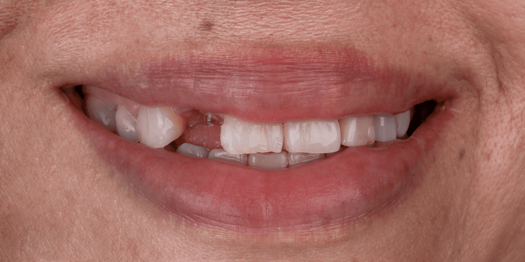 Before Zirconia dental implant in aesthetic zone