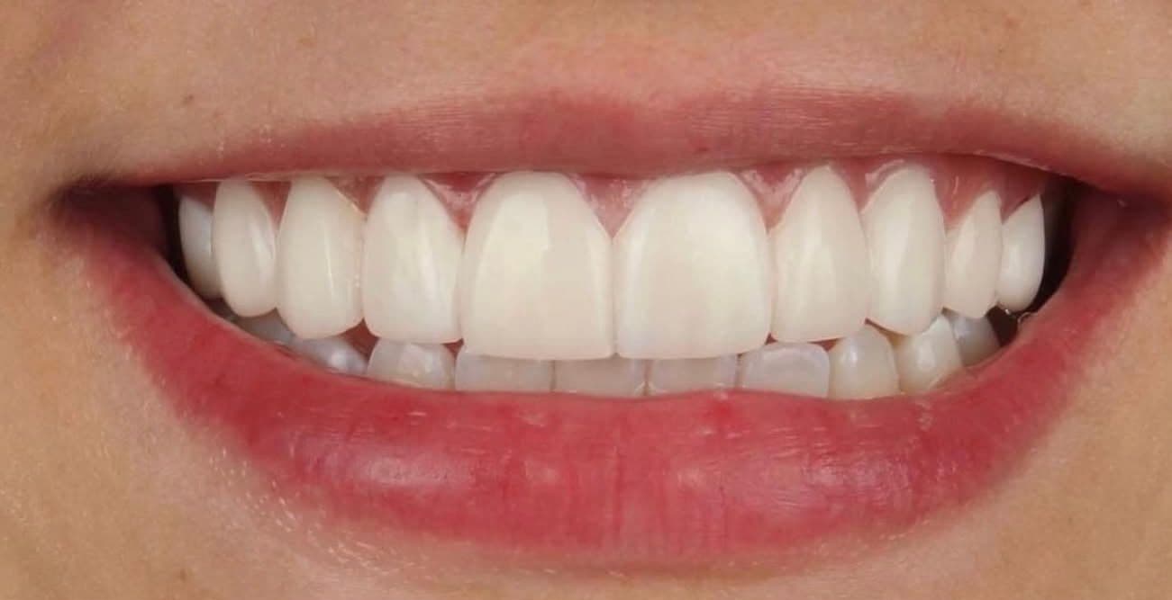 After ceramic dental veneers