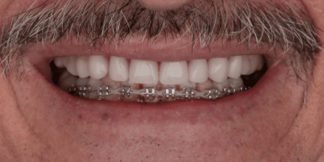 After Upper hybrid prosthesis