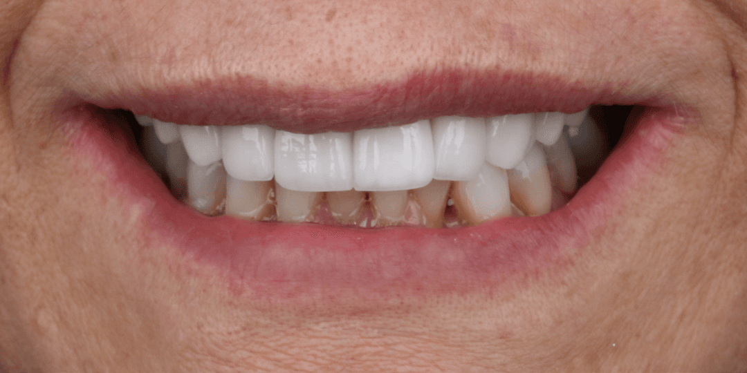 After Dental implant in aesthetic zone