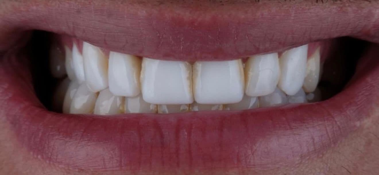 Before ceramic dental veneers