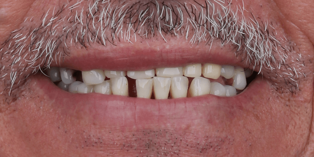 Before Upper hybrid prosthesis