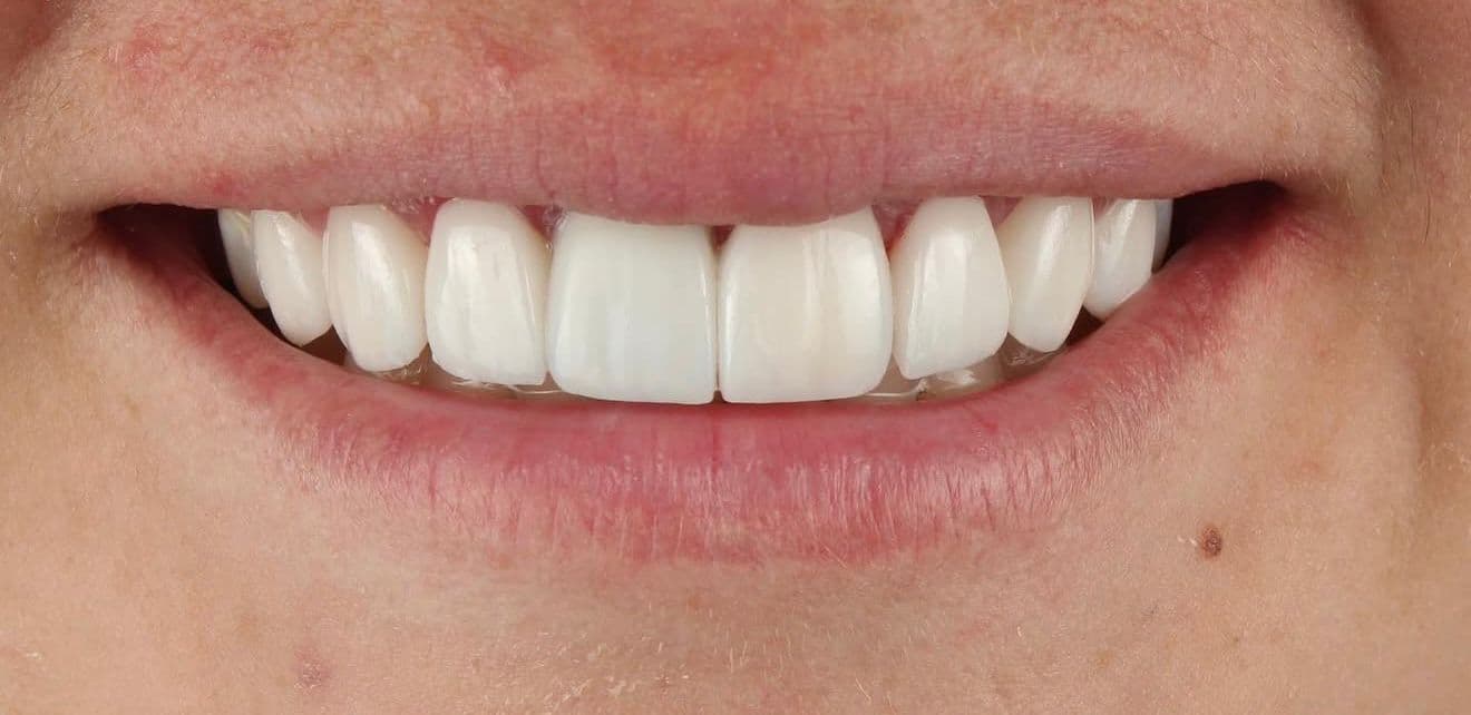 After ceramic dental veneers