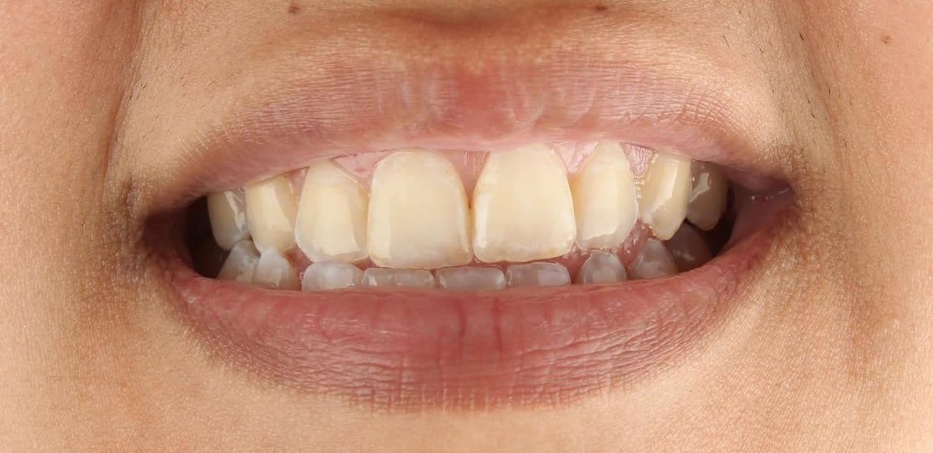 Before ceramic dental veneers