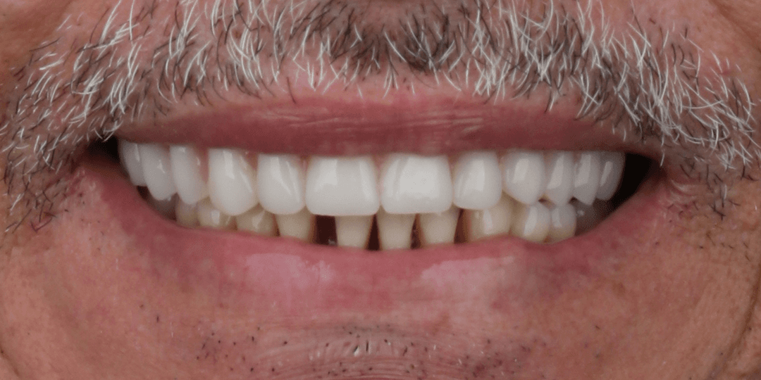 After Upper hybrid prosthesis