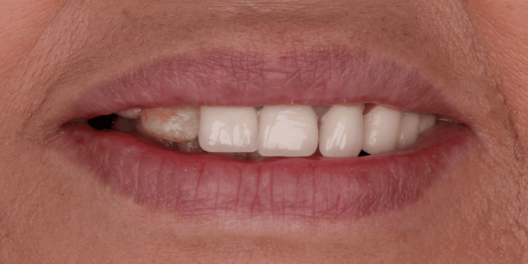 Before Upper hybrid prosthesis