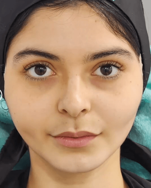 After Non-surgical Facial Sculpting and Contouring