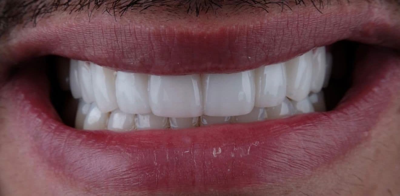 After ceramic dental veneers