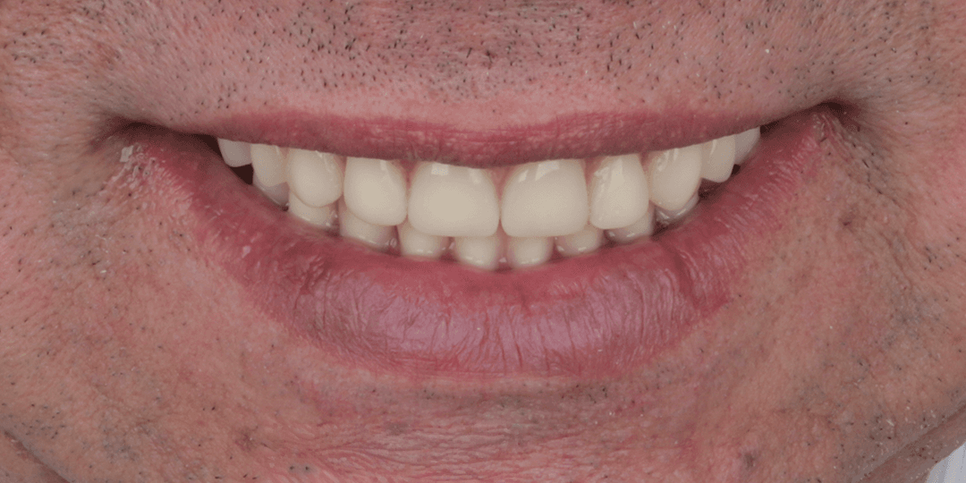 After Bimaxillary hybrid prosthesis