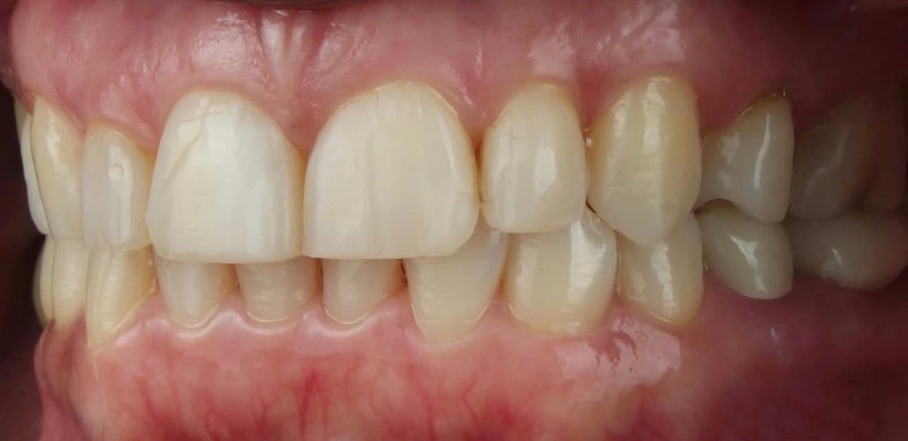 Before ceramic dental veneers