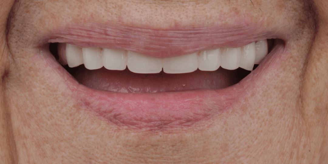After Upper hybrid prosthesis
