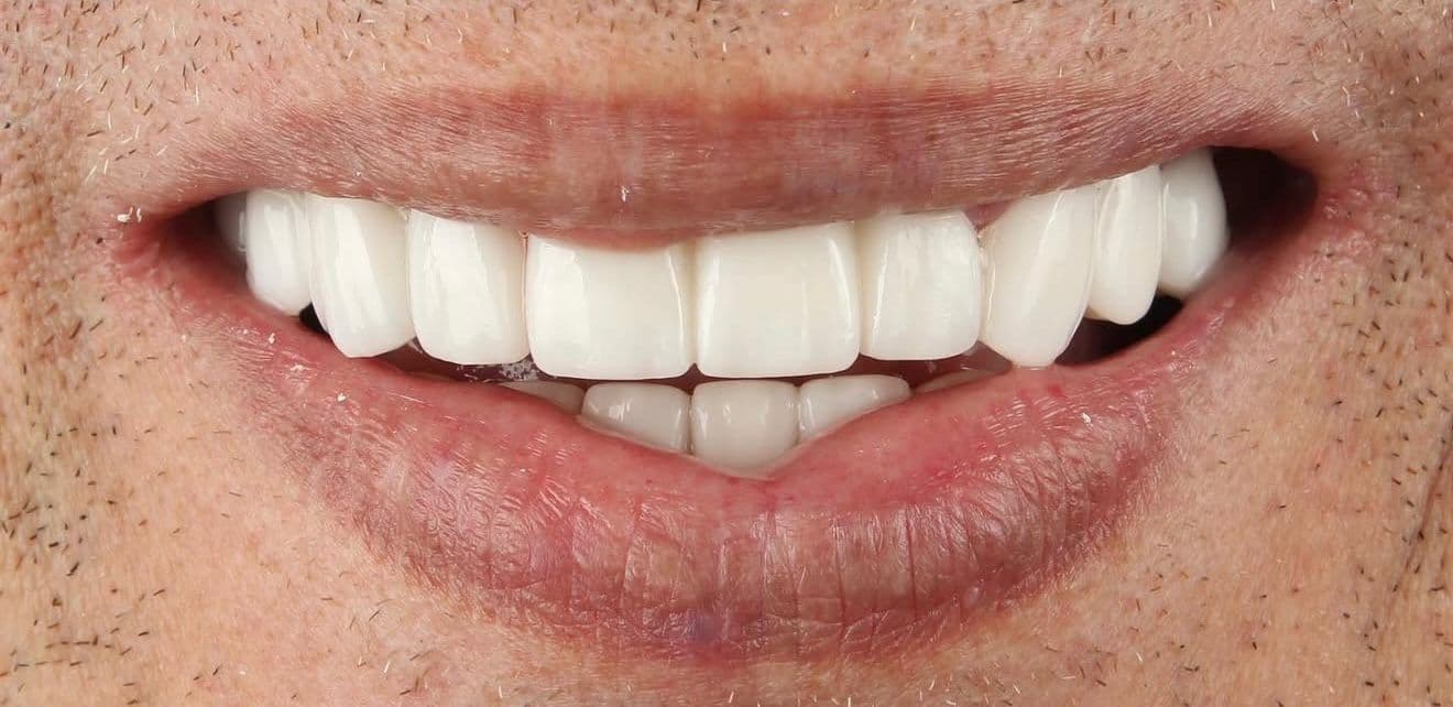 After ceramic dental veneers